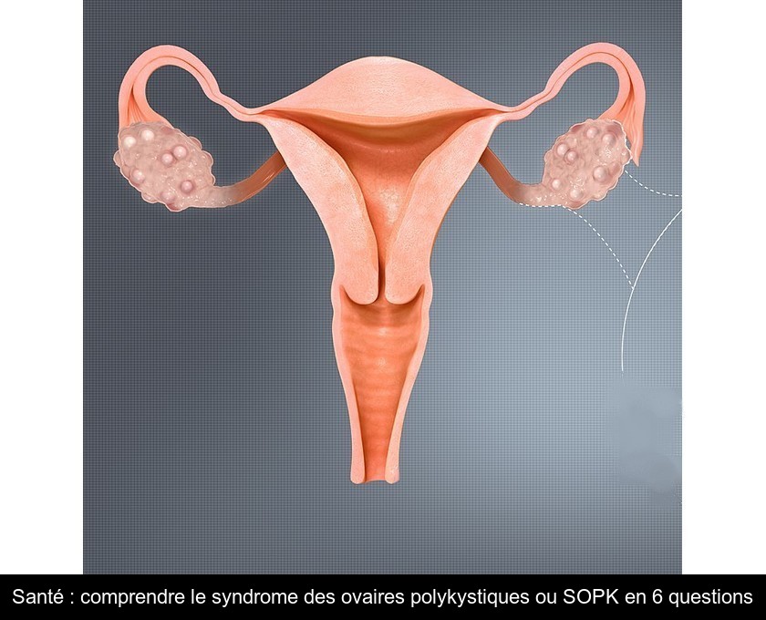 Santé : comprendre le syndrome des ovaires polykystiques ou SOPK en 6  questions